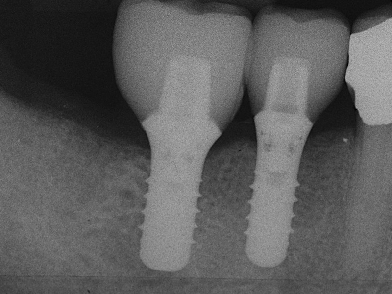 Röntgenkontrolle Implantate