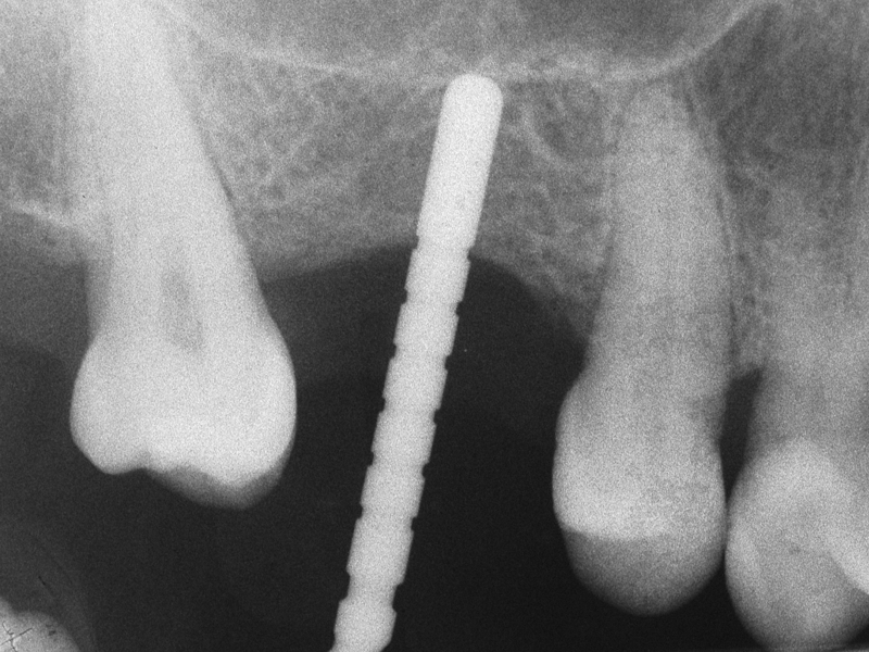 1 Implantat-Bohrung bis zum Boden der Kieferhöhle