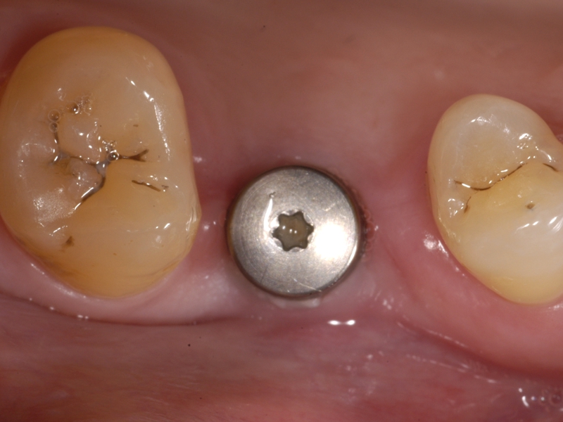 3 eingeheiltes Implantat